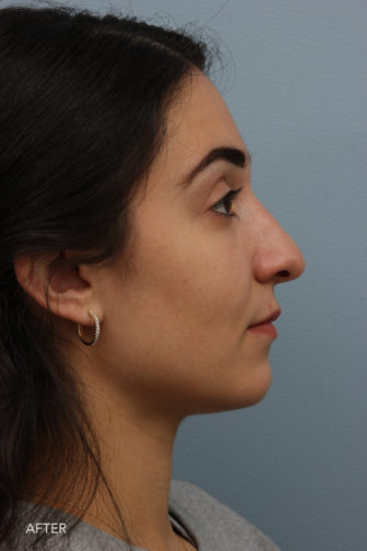 side profile image of a younger woman after rhinoplasty surgery with a flattering nose that fits her face