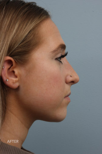 side profile image of a young female brunette after a rhinoplasty surgery showing a visible nasal hump