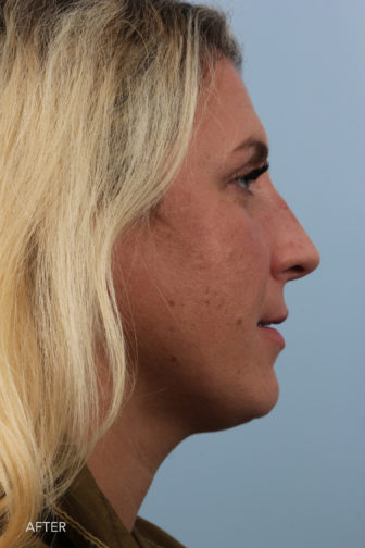side profile image of a younger woman after rhinoplasty surgery with a straight sloped nose that fits her face