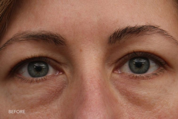 close up frontal view of a woman with green eyes before blepharoplasty or eyelid surgery dark bags under her eyes