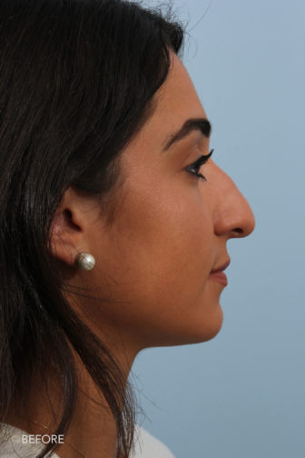 side profile image of a younger woman before rhinoplasty surgery with a droopy nose