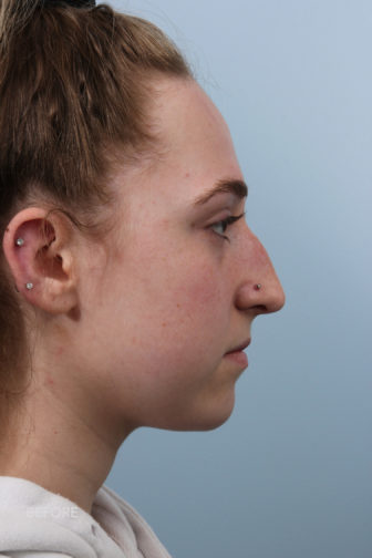 side profile image of a young female brunette before a rhinoplasty surgery showing a visible nasal hump
