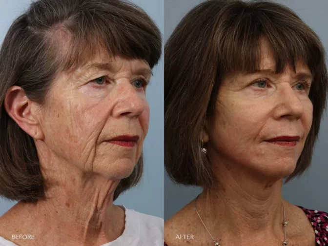 A side-by-side view of a woman's face before and after Deep Plane Lower Face and Neck Lift procedure. Before photo shows loose skin, resulting folds or creases along her jawline and under her chin. While the after photo shows a lifted sagging muscles, resulting a more improved definition of the jawline and a smoother neck contour. | Albany, Latham, Saratoga NY, Plastic Surgery