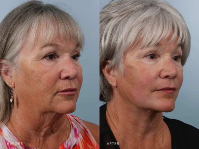 A side-by-side view of a woman's face before and after Deep Plane Lower Face and Neck Lift procedure. Before photo shows loose skin, resulting folds or creases along her jawline and under her chin. While the after photo shows a lifted sagging muscles, resulting a more improved definition of the jawline and a smoother neck contour. | Albany, Latham, Saratoga NY, Plastic Surgery