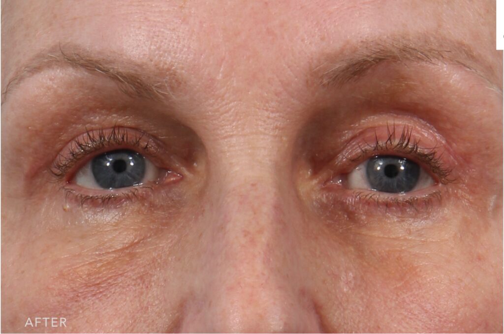 after photos of a woman who undertook a blepharoplasty surgery by Dr. Williams