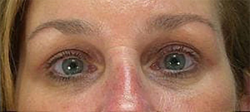 woman in need of blepharoplasty due to upper-eyelid sagging and restricting her vision