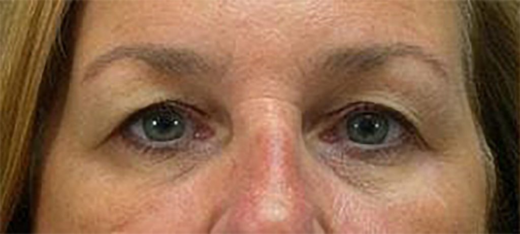 When is a Blepharoplasty Medically Necessary?</span>