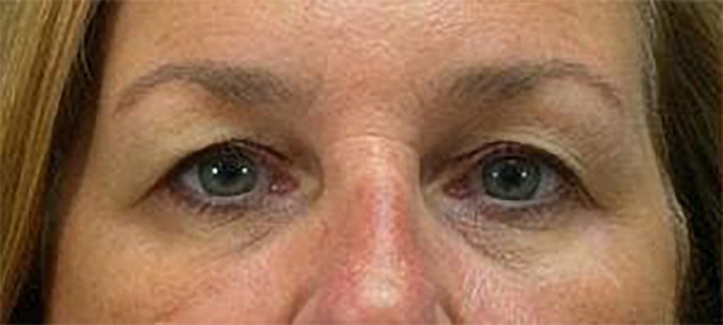 woman after a blepharoplasty that was restricting her vision due to upper-eyelid sagging