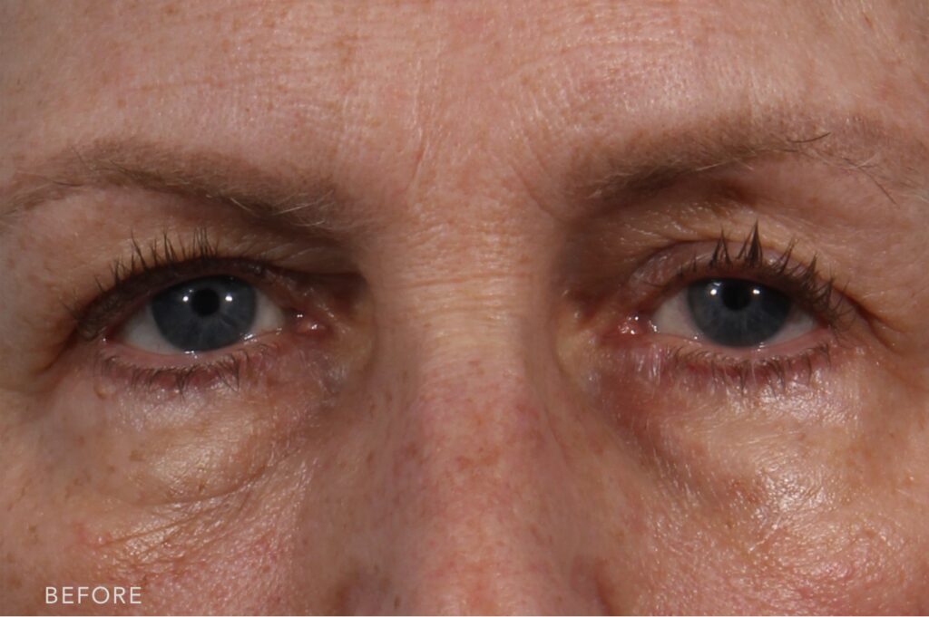 before photos of a woman who undertook a blepharoplasty surgery by Dr. Williams
