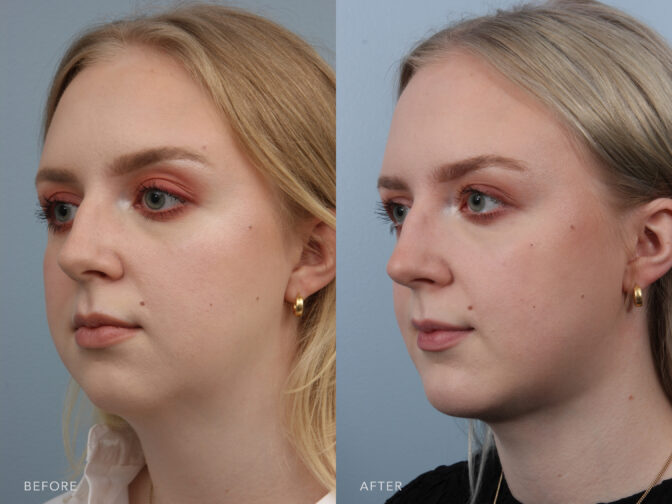 Side by side before and after of a young blonde woman who had chin augmentation surgery at The Williams Center in Albany NY. Her jawline is more defined and the separation between her face and neck is now clearly visible. | Albany, Latham, Saratoga NY, Plastic Surgery