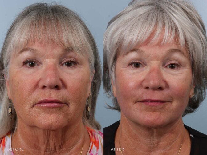globo Sinceridad Deber Laser Skin Resurfacing Before & After Photos | Williams Center Williams  Center