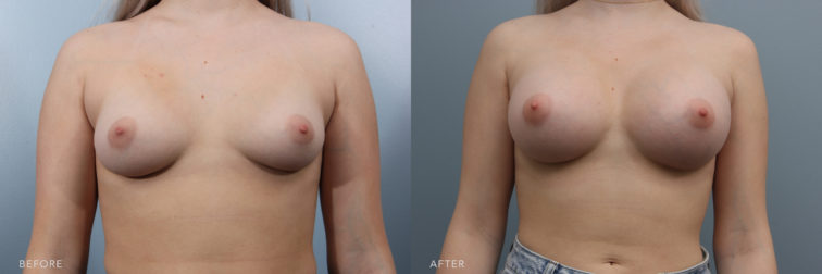 This is a side by side before and after of a woman pre and post op from a breast augmentation surgery. She had small breasts to begin with and now she has bigger, fuller, rounder breasts post operation. | Albany, Latham, Saratoga NY, Plastic Surgery