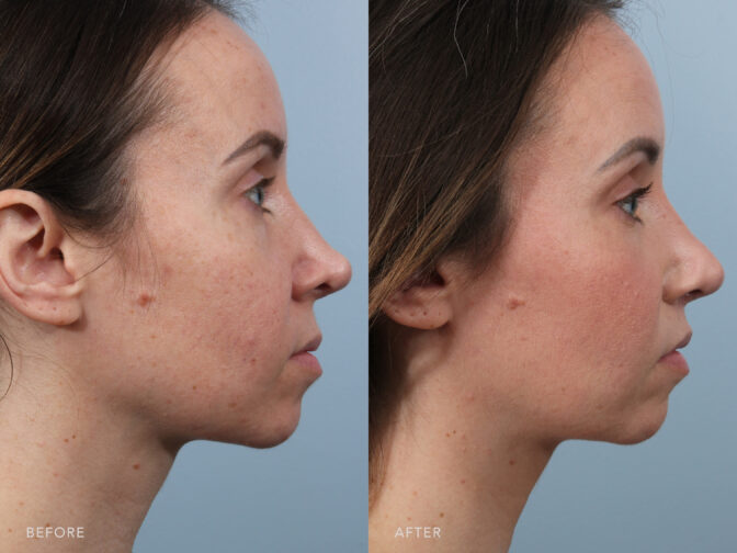 This is a side by side view of a woman before and after revision tip rhinoplasty surgery in Albany, NY. | Albany, Latham, Saratoga NY, Plastic Surgery