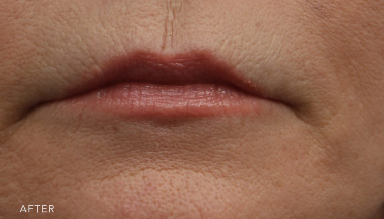 This is an after photo of a woman with a fuller top lift after lip lift surgery. | Albany, Latham, Saratoga NY, Plastic Surgery