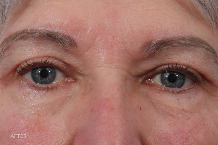 This is a front view of an older woman after blepharoplasty surgery with visibly wider eyes and no more hooded, droopy eyelids. | Albany, Latham, Saratoga NY, Plastic Surgery