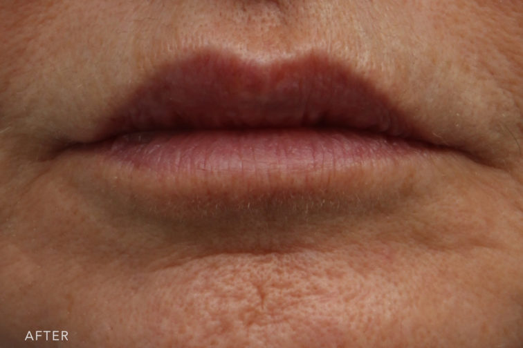 This is a close up photo of a woman's lips looking fuller after lip lift surgery. | Albany, Latham, Saratoga NY, Plastic Surgery