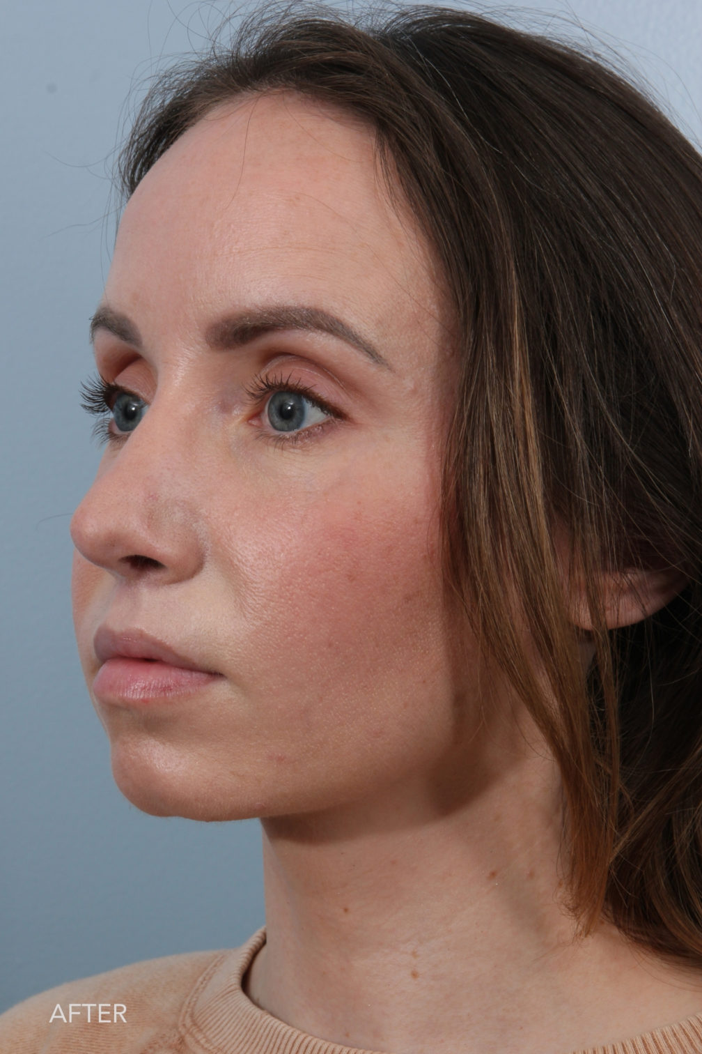 Rhinoplasty & Nasal Reconstruction Pictures | Williams Center Williams ...