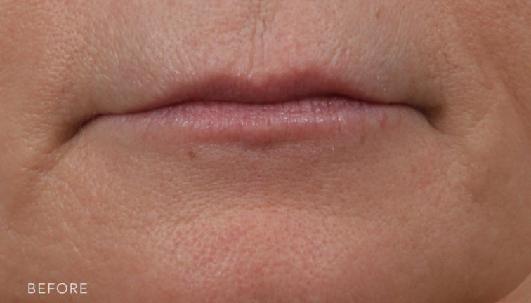 This is a before photo of a woman with thin lips before a lip lift surgery. | Albany, Latham, Saratoga NY, Plastic Surgery