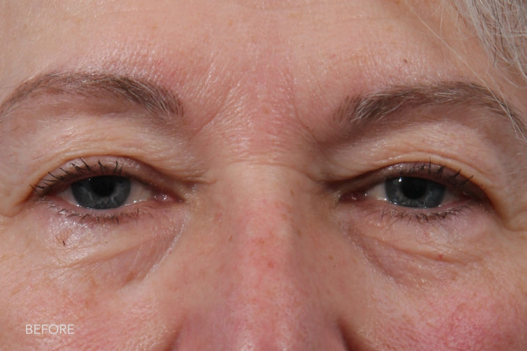 This is a front view of an older woman before blepharoplasty surgery with droopy hooded eyelids. | Albany, Latham, Saratoga NY, Plastic Surgery