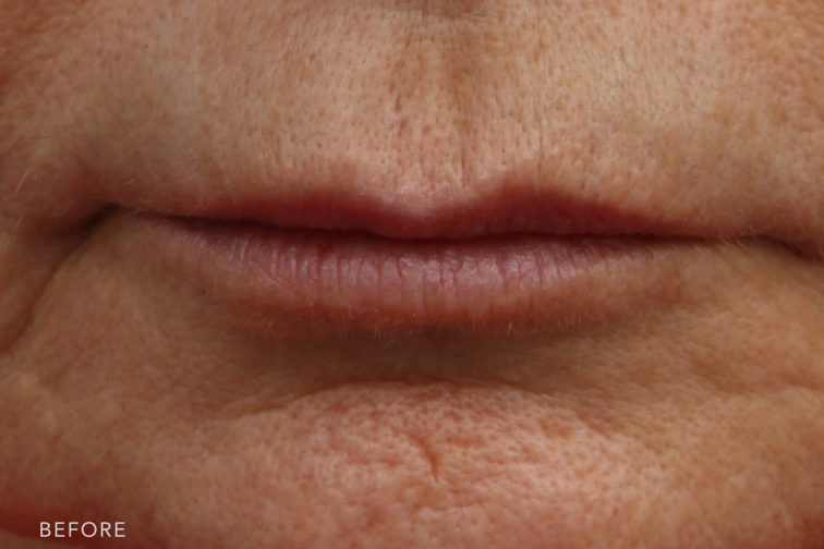This is a close up photo of a woman's thin lips before lip lift surgery. | Albany, Latham, Saratoga NY, Plastic Surgery