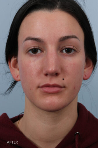 This is a photo of a young woman from straight on after rhinoplasty surgery in Albany, NY. Her nose is smaller and straighter from the front. | Albany, Latham, Saratoga NY, Plastic Surgery