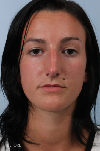 This is a photo of a young woman with large nasal hump before rhinoplasty surgery in Albany NY.