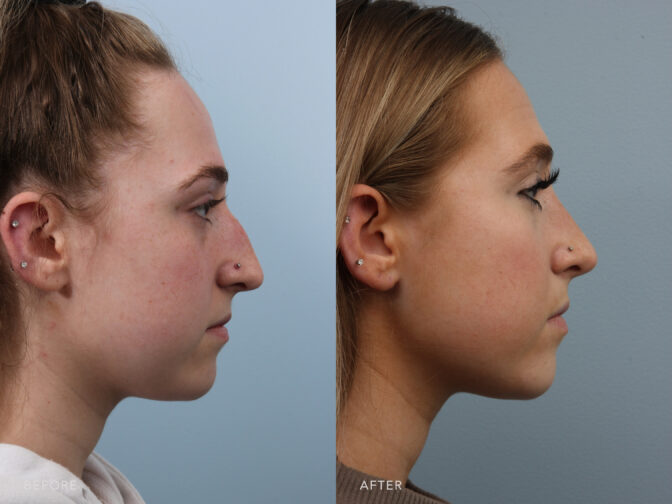 side by side view of a young woman who had Rhinoplasty surgery in Albany, NY. Her nasal hump was removed and her nose is now straighter, smaller, and more feminine. | Albany, Latham, Saratoga NY, Plastic Surgery