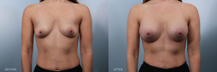 This is a thumbnail photo of a side by side comparison of a woman before and after breast augmentation surgery. She has a fuller and more lifted chest post surgery. | Albany, Latham, Saratoga NY, Plastic Surgery