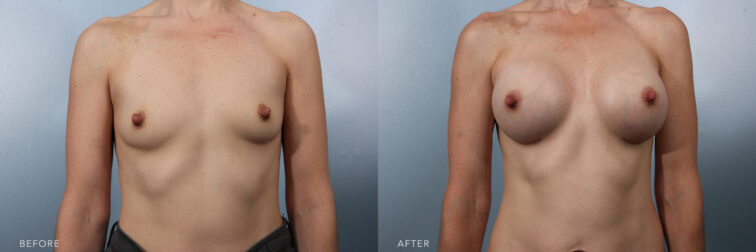 This is a side by side before and after transformation of a woman from the neck down to her belly button showing her flat chest before breast augmentation surgery and her new fuller and bigger chest after surgery. | Albany, Latham, Saratoga NY, Plastic Surgery