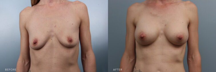 This is a side by side before and after of a woman who had breast augmentation surgery in Albany, NY. | Albany, Latham, Saratoga NY, Plastic Surgery