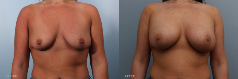This is a side by side before and after of a woman who had small flat breasts who now has round and full breasts after undergoing breast augmentation surgery. | Albany, Latham, Saratoga NY, Plastic Surgery