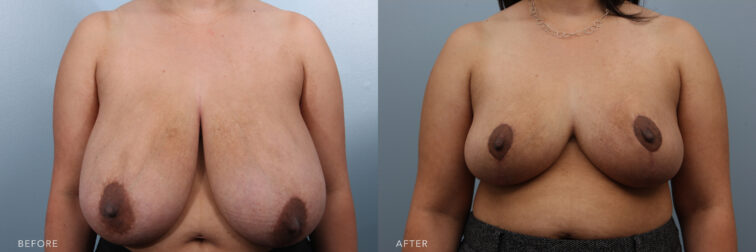 This is a side by side before and after photo of a woman's breasts before and after breast reduction surgery. They were drooping down to her belly button before surgery and now they are smaller and lifted to where they are supposed to be. | Albany, Latham, Saratoga NY, Plastic Surgery