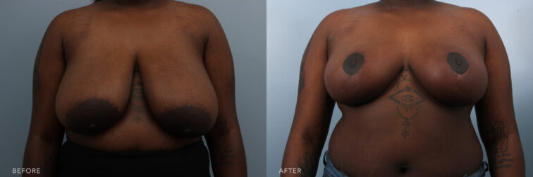 This is a side by side before and after photo of a woman from the neck down to her midsection showing her large drooping breasts before breast reduction surgery and after showing her much smaller and lifted breasts. | Albany, Latham, Saratoga NY, Plastic Surgery