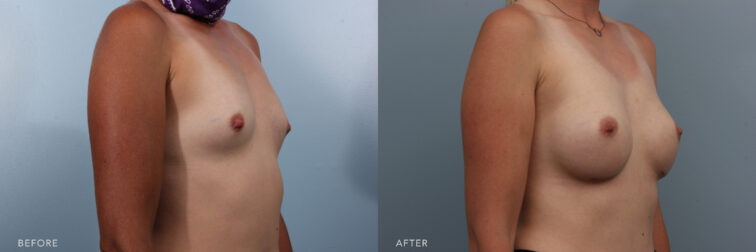 This is a side by side photo of a woman with a small chest before breast augmentation surgery in Albany, NY, to a bigger chest after. | Albany, Latham, Saratoga NY, Plastic Surgery