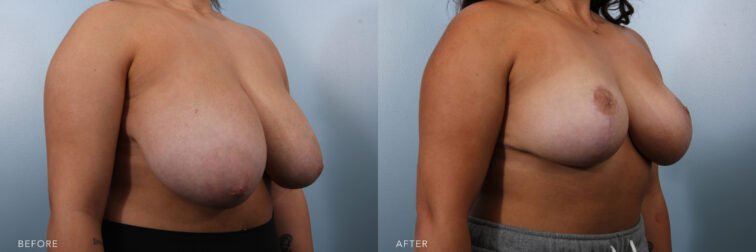 This is a side by side transformation photo of a woman who had breast reduction surgery in Albany, NY. She went down several cup sizes and her breasts went from hanging to her belly button to being lifted back to an optimal location. | Albany, Latham, Saratoga NY, Plastic Surgery