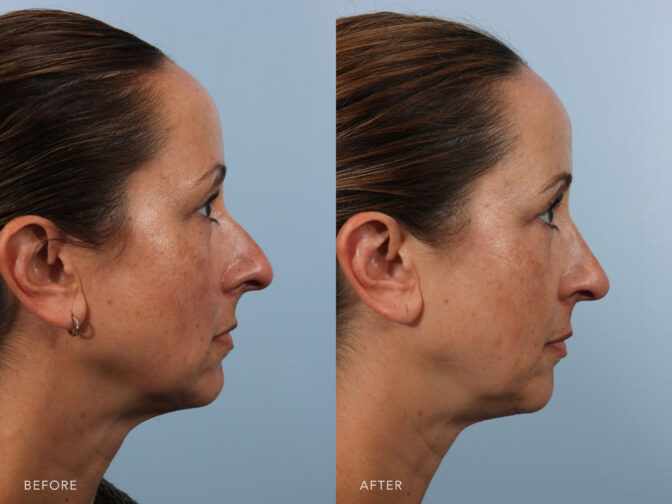 This is a profile view thumbnail of a woman before and after rhinoplasty surgery in Albany, NY, with a smaller feminine nose. | Albany, Latham, Saratoga NY, Plastic Surgery