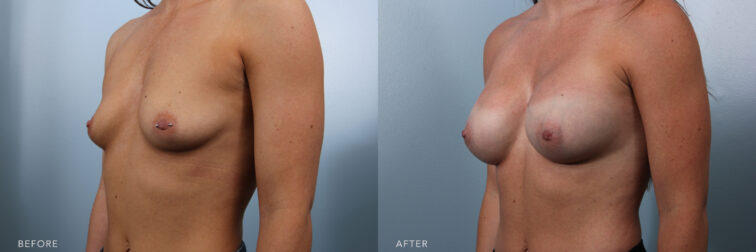 This is an angled side by side view of a woman's flat chest compared to a fuller and rounder chest after breast augmentation surgery in Albany, NY. | Albany, Latham, Saratoga NY, Plastic Surgery