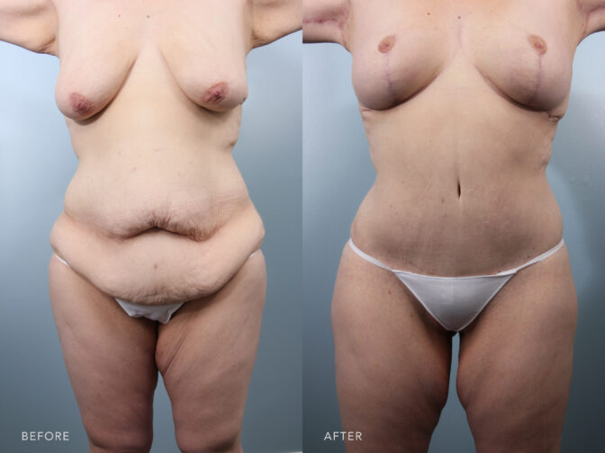 Side by side transformation photo of a woman's body before and after mommy makeover surgery. Excess skin and fat in her midsection has been removed and her breasts have been lifted. | Albany, Latham, Saratoga NY, Plastic Surgery