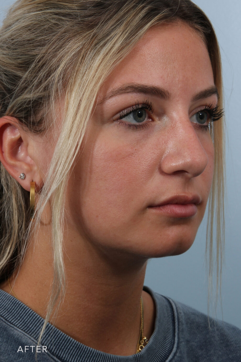 Rhinoplasty & Nasal Reconstruction Gallery | The Williams Center ...