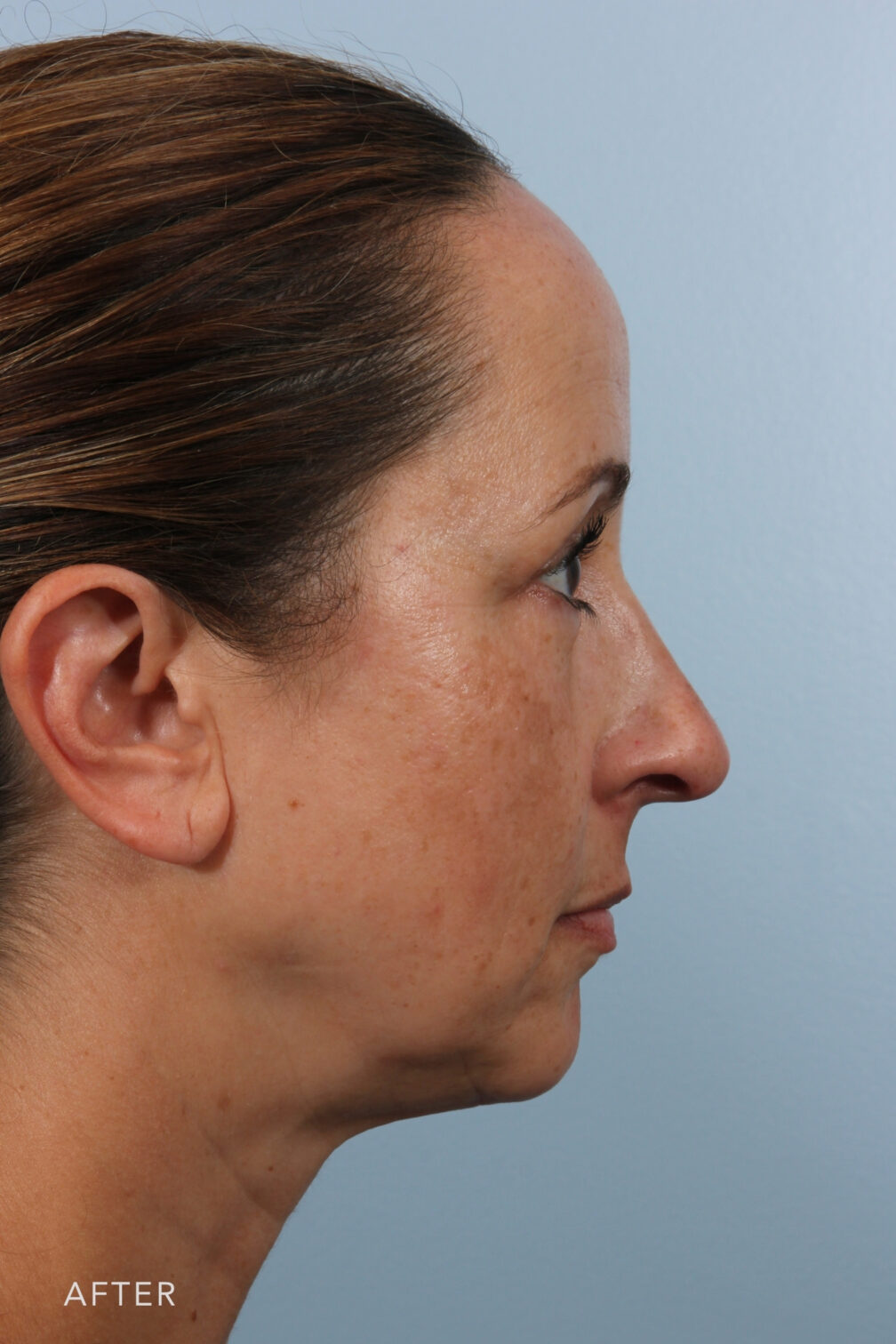 Rhinoplasty & Nasal Reconstruction Gallery | The Williams Center ...
