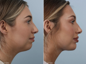 Results of a chin augmentation surgery done at The Williams Center