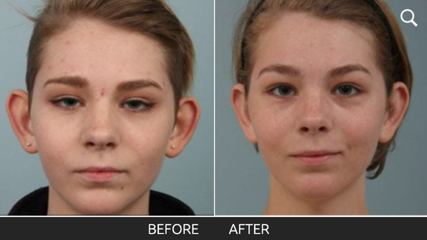 before and after picture of a teenage girl following an otoplasty surgery