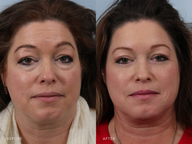 Side by side before and after of a middle aged woman who had blepharoplasty surgery done in Albany, NY. Excess skin and fat around her eyes have been removed leaving her looking younger and brighter. | Albany, Latham, Saratoga NY, Plastic Surgery
