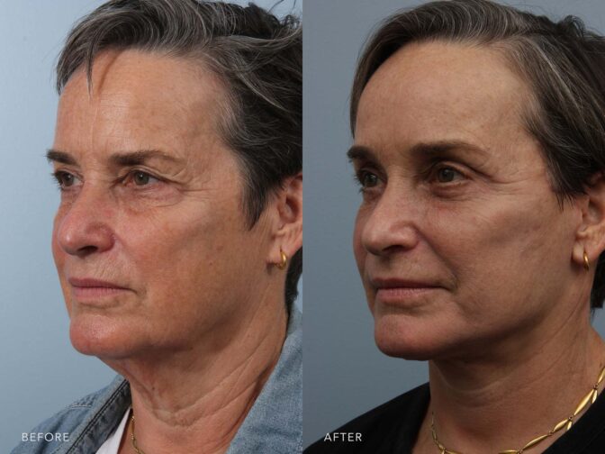 Side by side before and after of a middle aged woman who had facelift surgery in Albany, NY. Excess skin and fat around the neck and face has been removed and she looks much younger. | Albany, Latham, Saratoga NY, Plastic Surgery