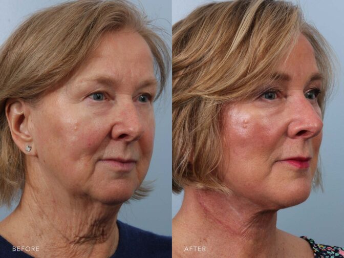 Side by side of an older blonde woman before and after facelift surgery in Albany, NY. Excess skin around the neck and face have been removed and she looks years younger. | Albany, Latham, Saratoga NY, Plastic Surgery