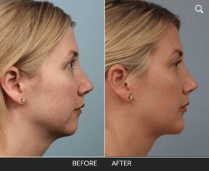 side profile before and after photos of a middle-aged women who receive a chin implant 