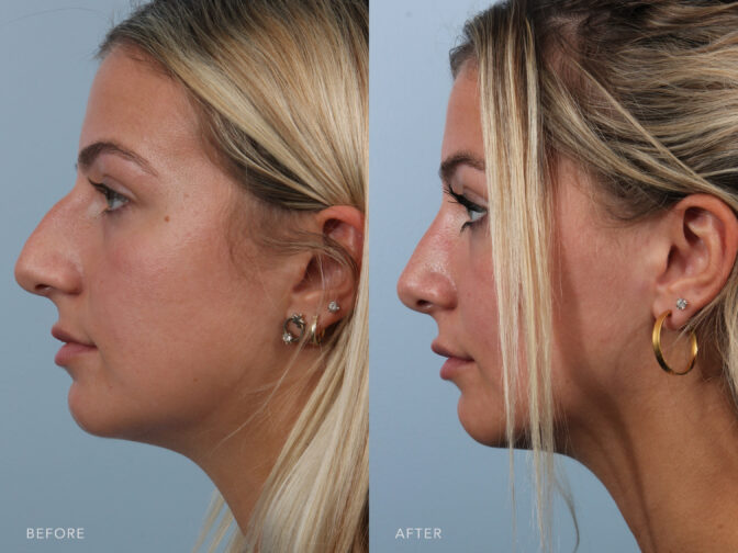 Side by side before and after of a young blonde woman who had a rhinoplasty done in Albany, NY. Her nasal hump was removed and her nose is smaller and more feminine. | Albany, Latham, Saratoga NY, Plastic Surgery