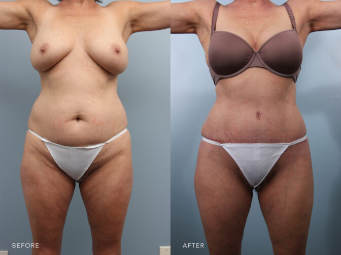 Side by side before and after of a woman who had a tummy tuck in Albany, NY. Excess skin and fat on her midsection has been removed and she now has a flat and toned stomach area. | Albany, Latham, Saratoga NY, Plastic Surgery