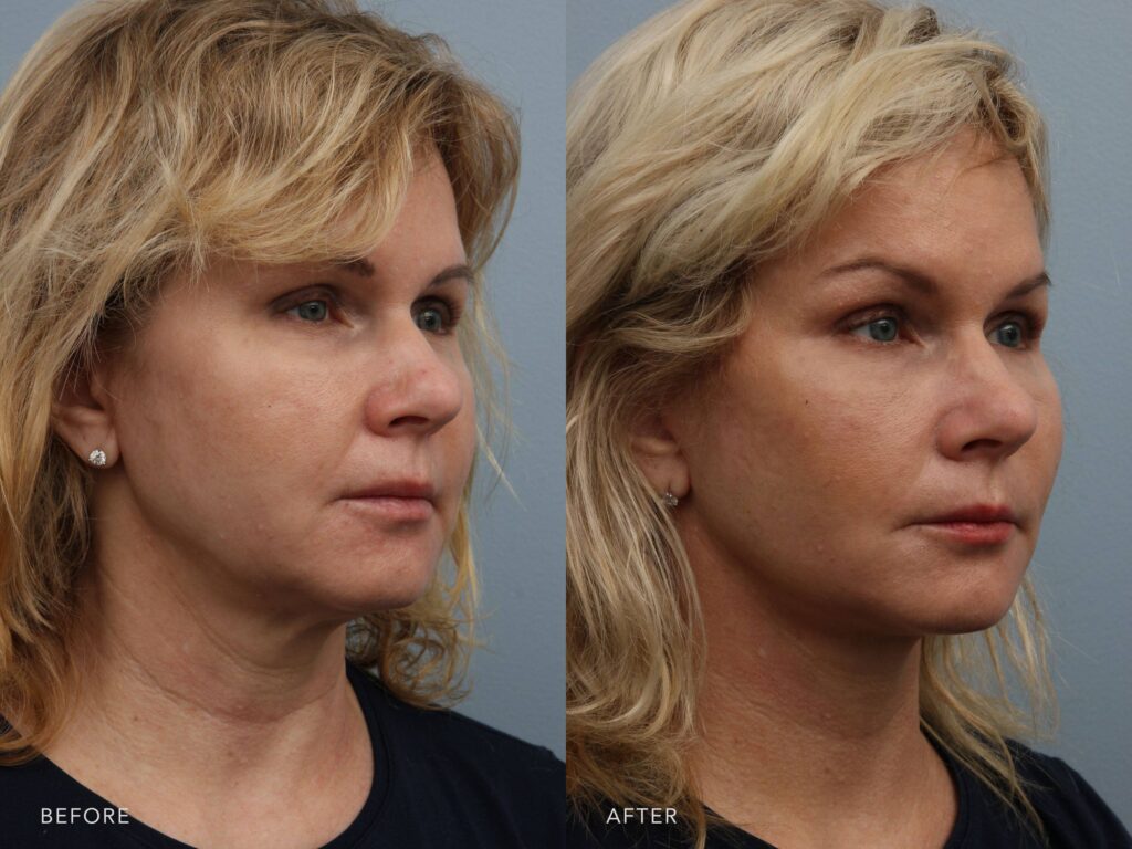 A side-by-side view of a woman's face before and after the Deep Plane Lower Face and Neck Lift procedure. The before photo shows a gentle slope that replaces the expected sharp angle at the jawline, diminishing facial structure and creating a less youthful outline. The after photo shows a crisp, angular jawline with a well-defined break between the chin and neck, enhancing facial structure and contributing to a more youthful, lifted appearance. | Albany, Latham, Saratoga NY, Plastic Surgery