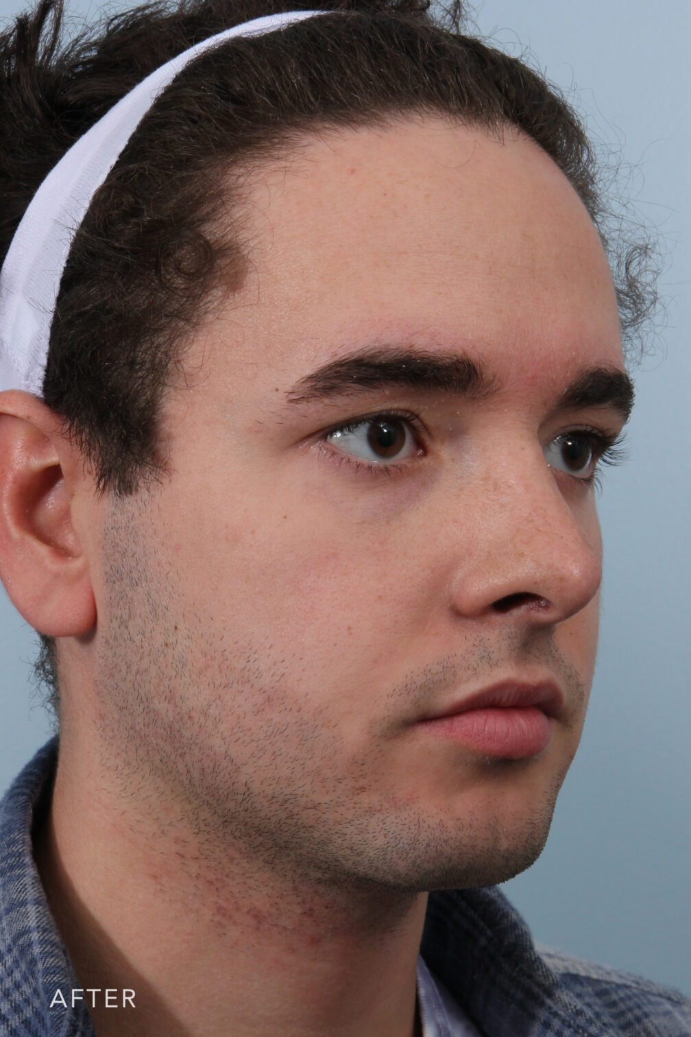 Rhinoplasty & Nasal Reconstruction Gallery | The Williams Center ...